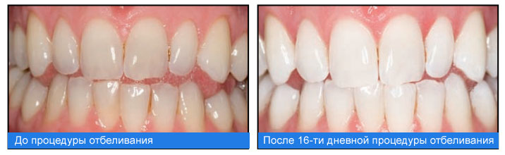 Методы домашнего отбеливания зубов